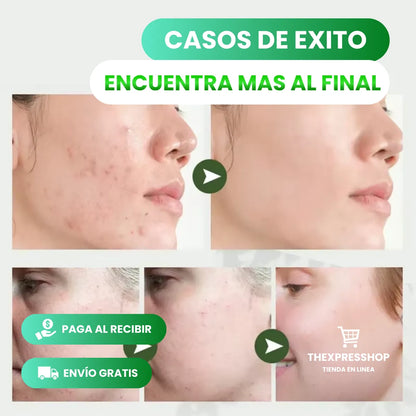 GREEN SKIN™ - Máscara de Té Verde y Arcilla Blanca [Anti grasa y acné]